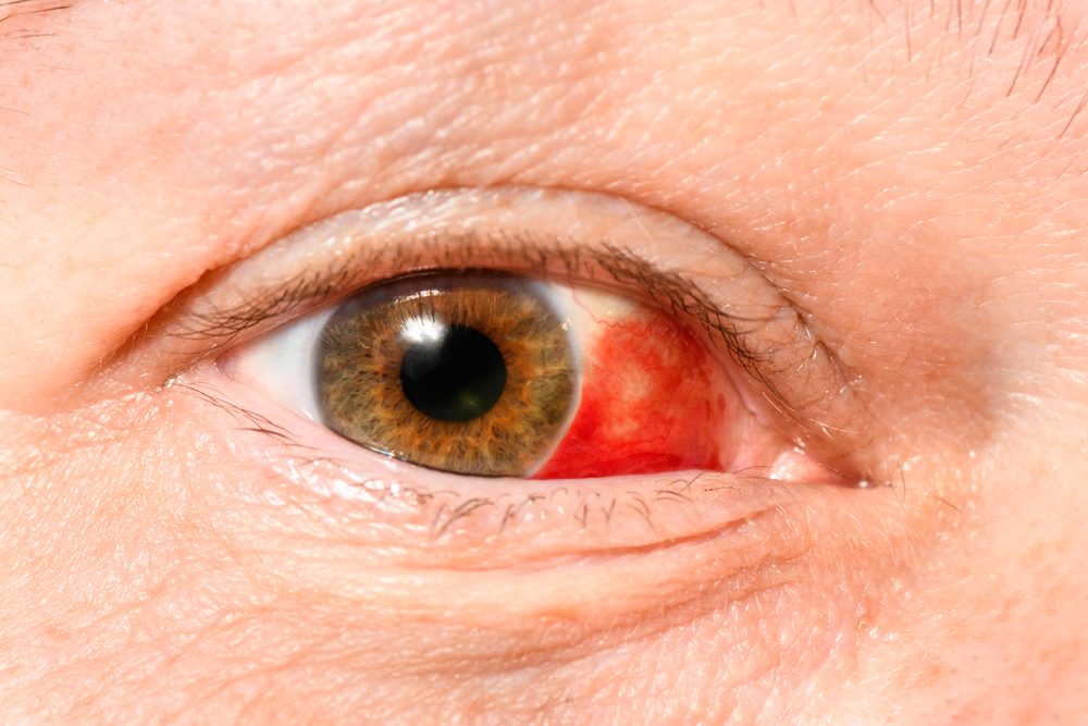 ¿Qué es una hemorragia subconjuntival?