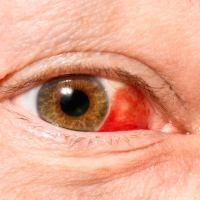 ¿Qué es una hemorragia subconjuntival?